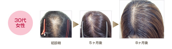 女性の薄毛を改善した症例をご紹介します 薄毛 Aga治療のあれこれ Dクリニック大阪 メンズ 旧脇坂クリニック大阪 の頭髪コラム