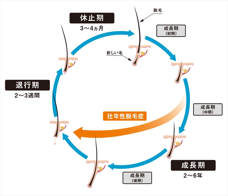 クリニック監修 抜け毛の細い毛の割合が気になる 多いとaga進行中 薄毛 Aga治療のあれこれ Dクリニック大阪 メンズ 旧脇坂クリニック大阪 の頭髪コラム